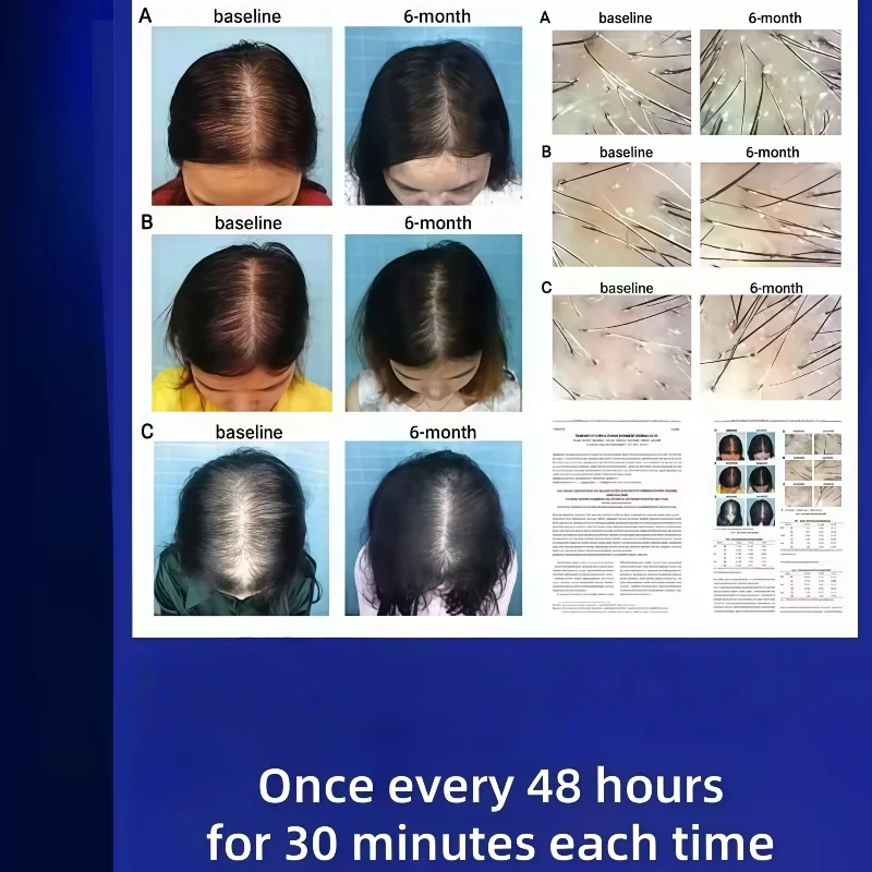 

Hair Loss Treatment Cap Red Light Laser Therapy for Thinning Hair and Baldness at Home