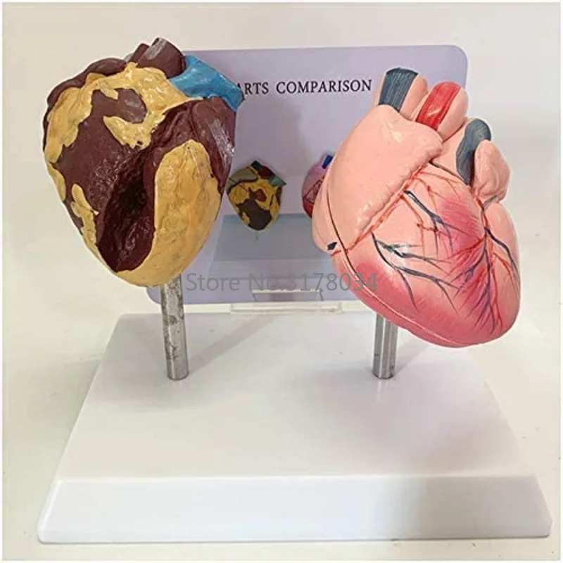 Human Heart Model Pathological Anatomical Heart Model Health and Smoking People Heart Comparison Model