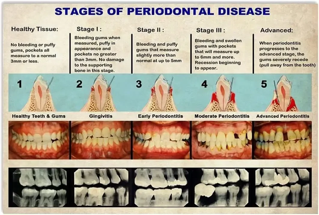 Dental Knowledge Metal Tin Signs Wall Decor Stages Of Periodontal Disease Infographic Posters Dentist Office Education Plaque Ho