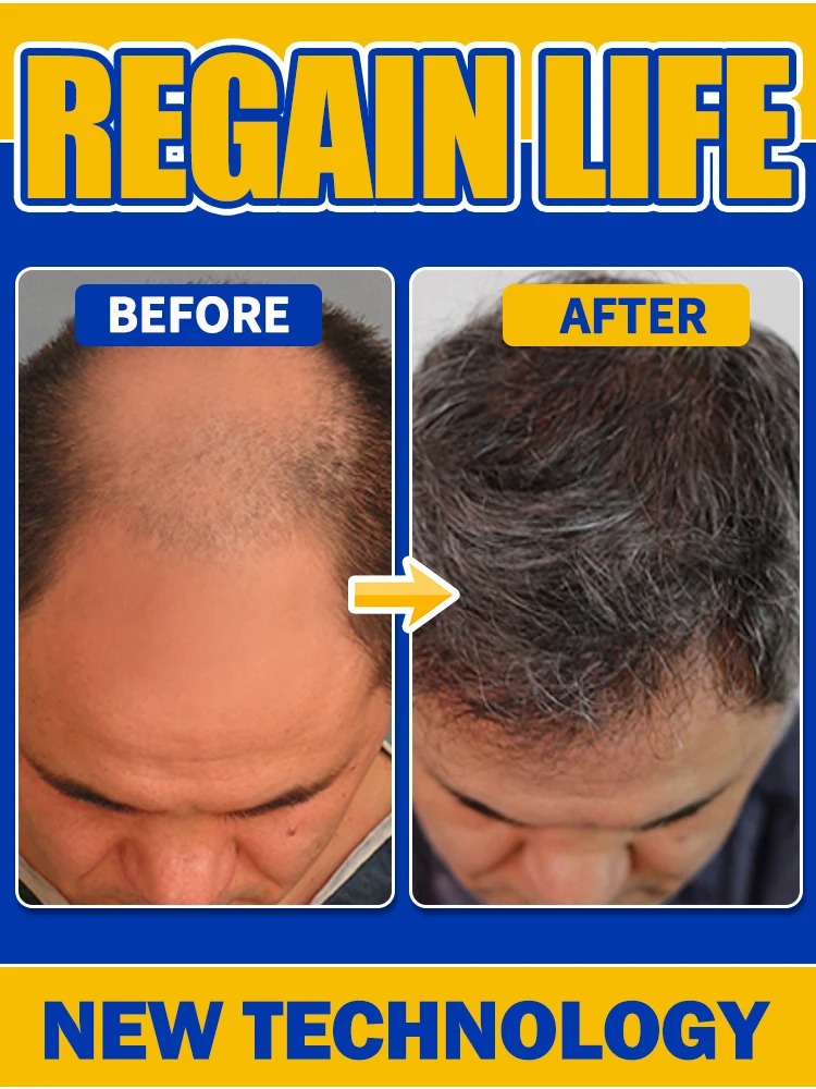 

Quick results hair is getting more and more, say goodbye to baldness, sparse hair starts to become thick