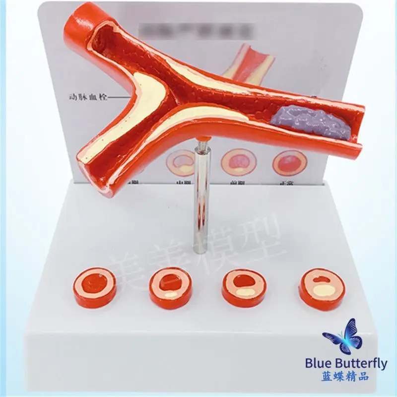 

Blockage of blood vessels, blood concentration, fat pathology, blood, human vascular pathology, anatomical model