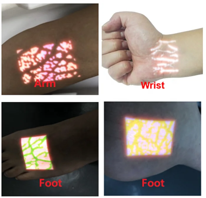 Clinic Nurse use Infrared Vein finder system with enhancer vein map for vessel finding