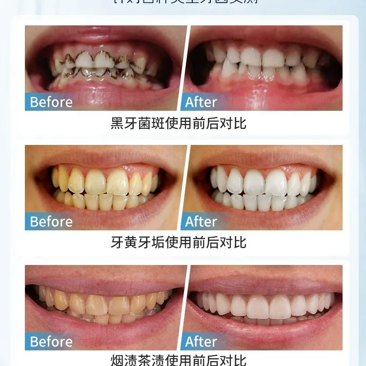 Japan Manual Tooth Stain Removal Brush Portable Teeth Plaque Remover for Oral Deep Cleaning Tooth Care Tool Powerfree Operation