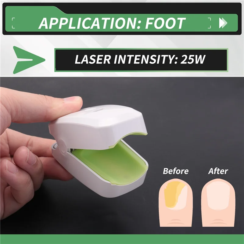 

AA47 905NM Nail Therapeutic Instrument Portable Painless Nail Laser Therapy Device Anti-Slip Silicone Durable Easy To Use