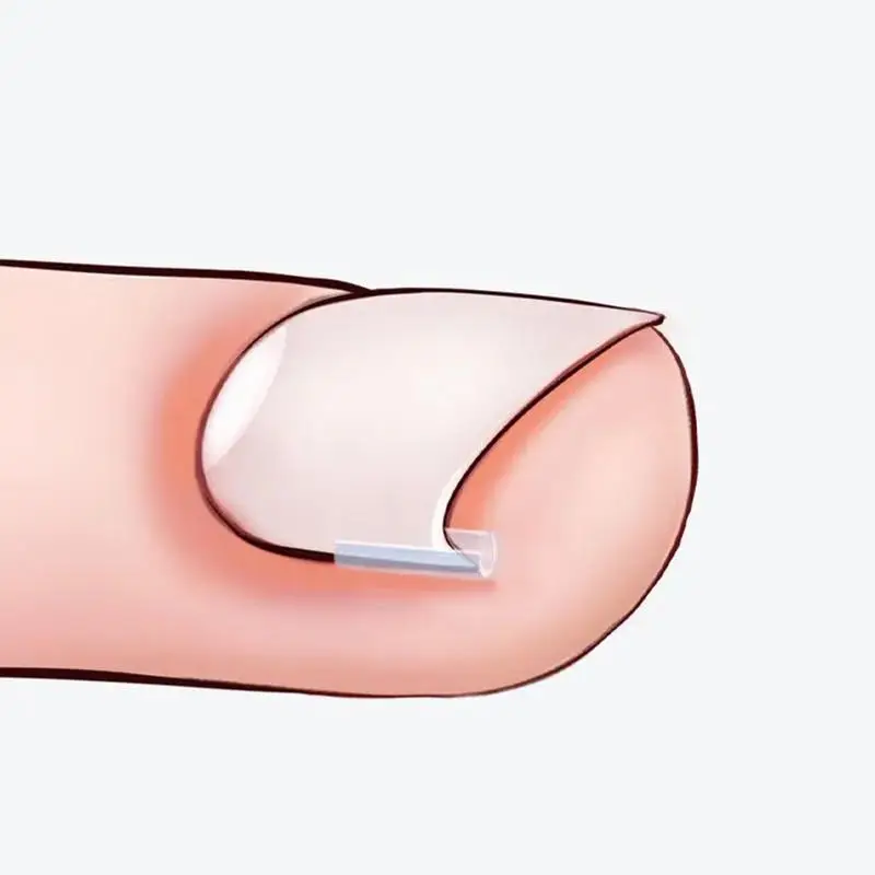 50/100PC 陥入爪矯正ツール陥入爪治療弾性パッチステッカー矯正クリップブレースペディキュアツール