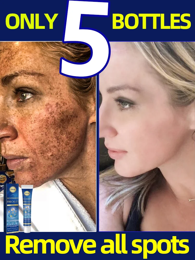 Freckle Melasma Eliminate brighten