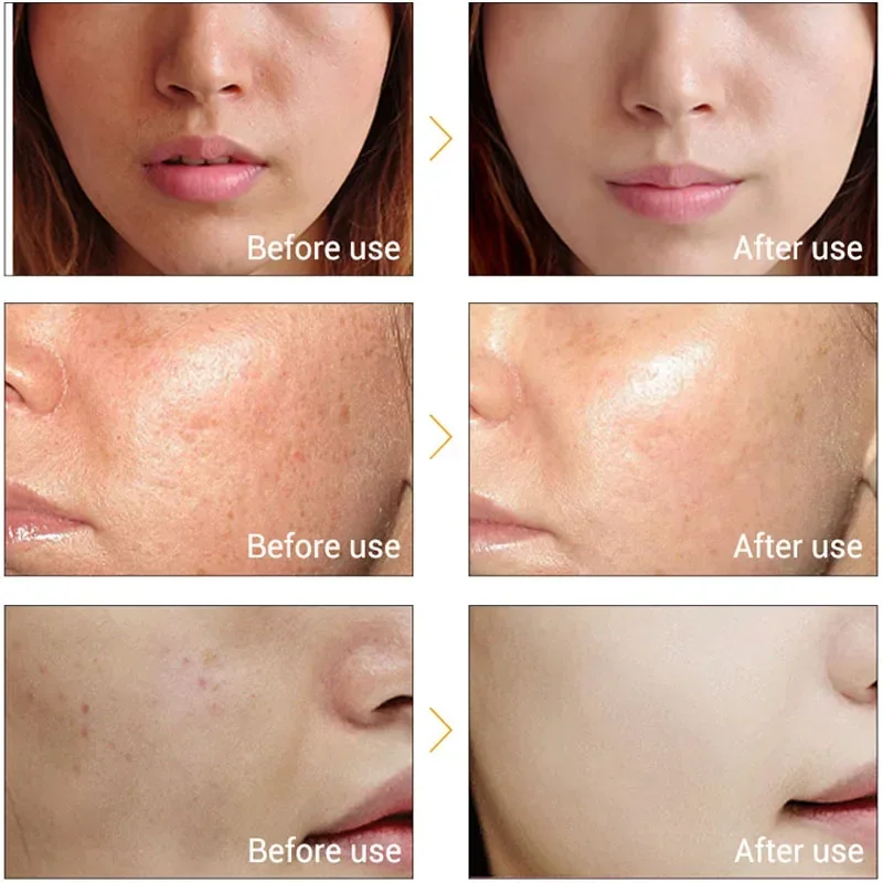 Mesotherapy ใบหน้า Electroporation RF และ EMS ความถี่วิทยุ Photon Face Lifting กระชับกําจัดริ้วรอย Skin Care เครื่องมือ