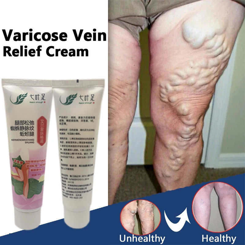 

20g Varicose Vein Cream Legs Dilated Vasculitis Pain Treat Ointment Earthworm Vein Repair Phlebitis Analgesics Care Dressing