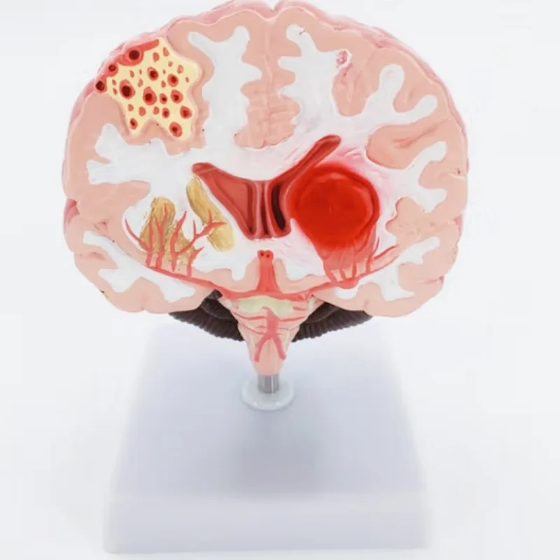 

Human pathological model, stroke medical teaching model