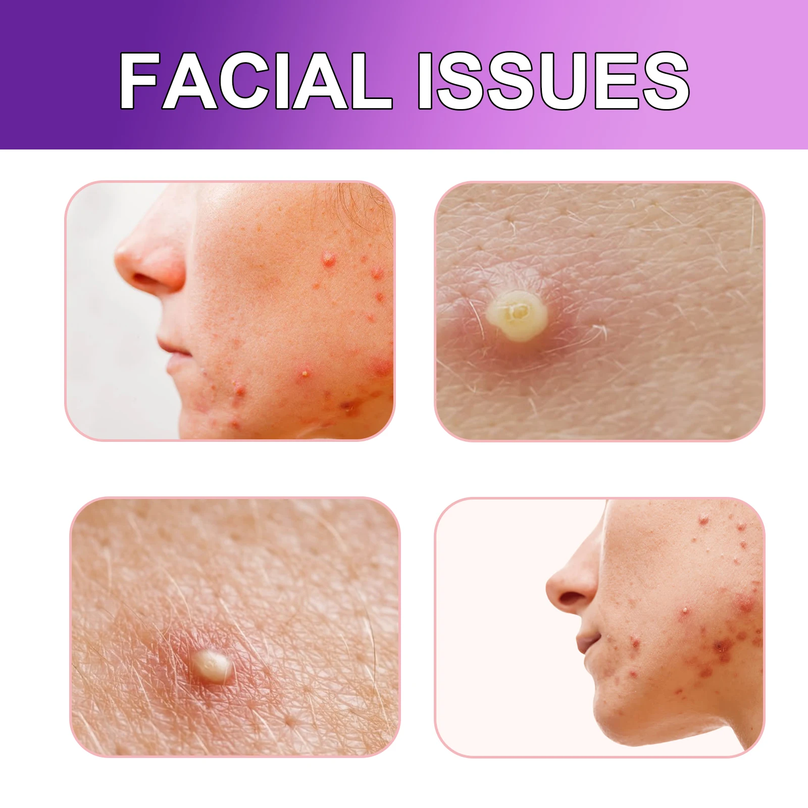 180pcs/Box Of Acne Patches Non Irritating Acne Stickers Various Patterns Acne Concealer Patch Ultra-Thin Fashion Patch Unisex view 4