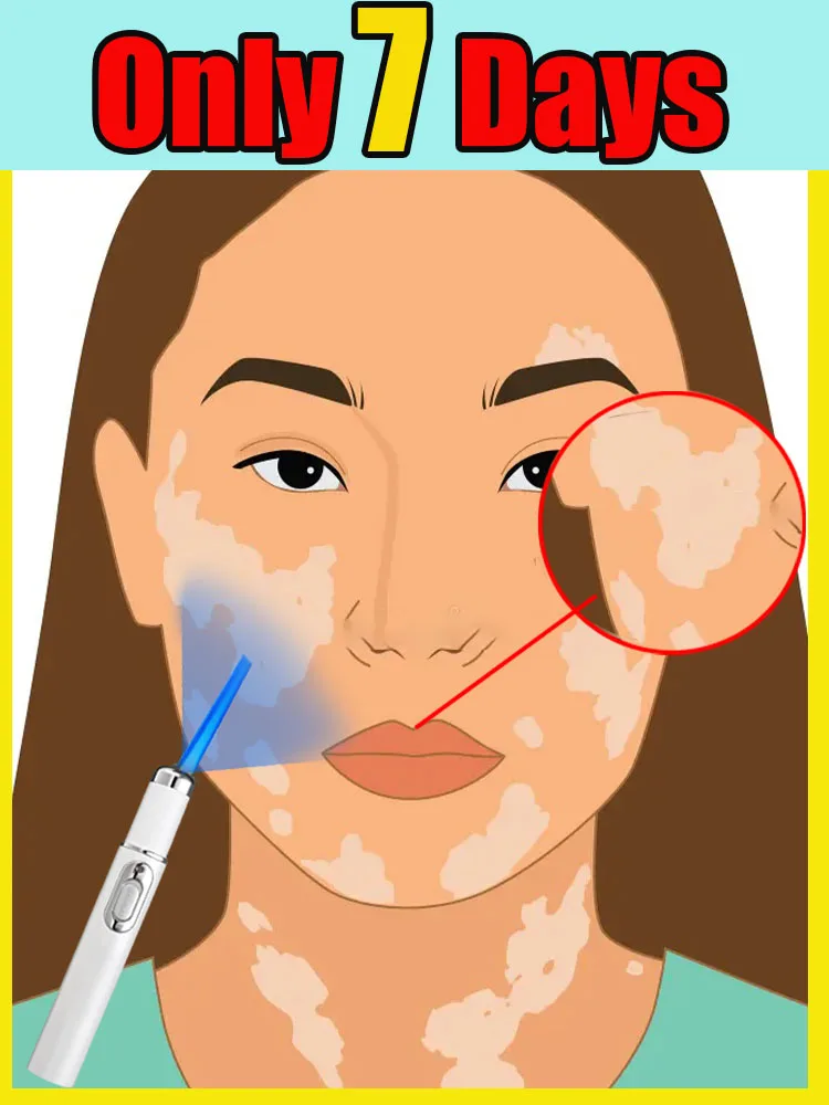 

Новейшая модернизированная ручка с синим светом для домашнего использования. Обеспечьте нежный опыт, лазерная указка. Инструменты для ухода за кожей.