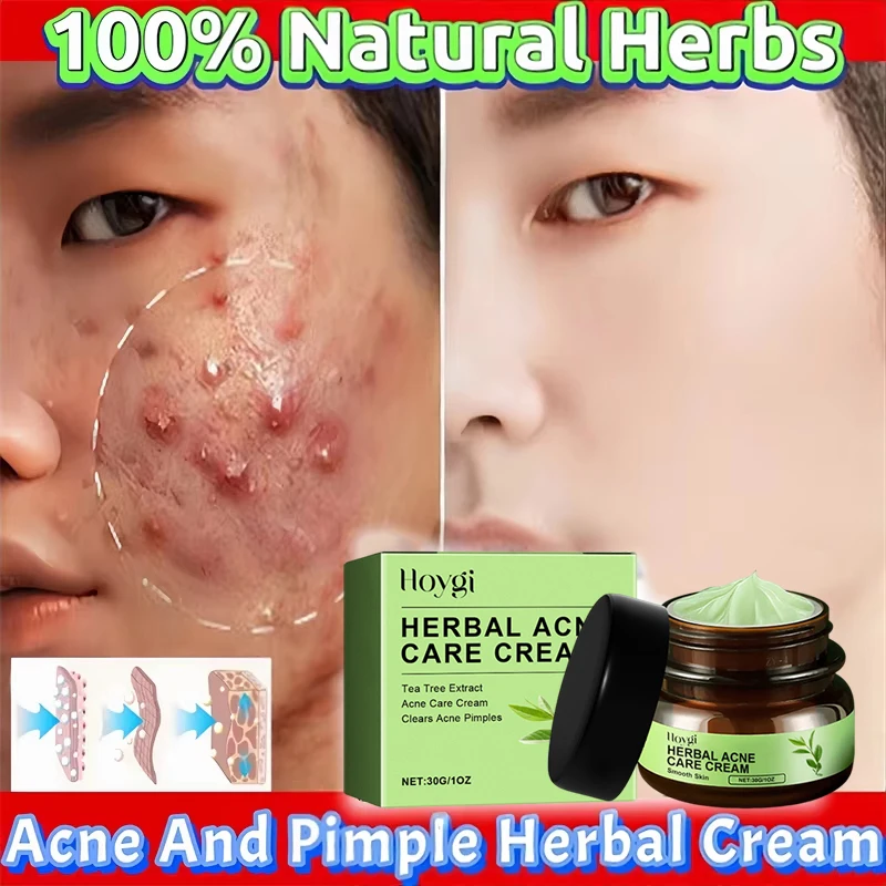 Crema para el acné, hierbas naturales, ácido, reduce los poros, puntos negros, cicatrices, marcas de acné, imperfecciones, Control de aceite, blanqueamiento, productos coreanos para el cuidado de la piel