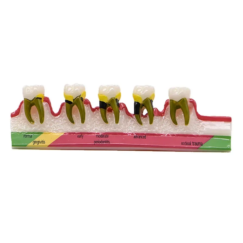 Dentals Model Periodontal Caries Development Classification Demonstration Model