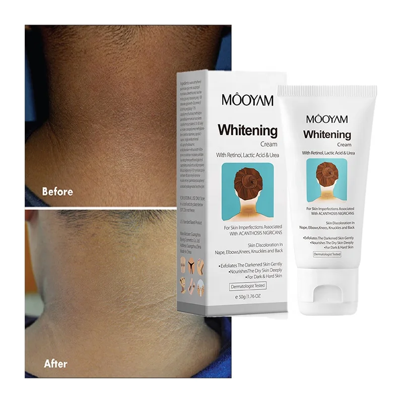 Organic Acanthosis Nigricans Treatment Cream Whitening Cream for Remove Black Patches Knee, Elbow, Neck, Underarm