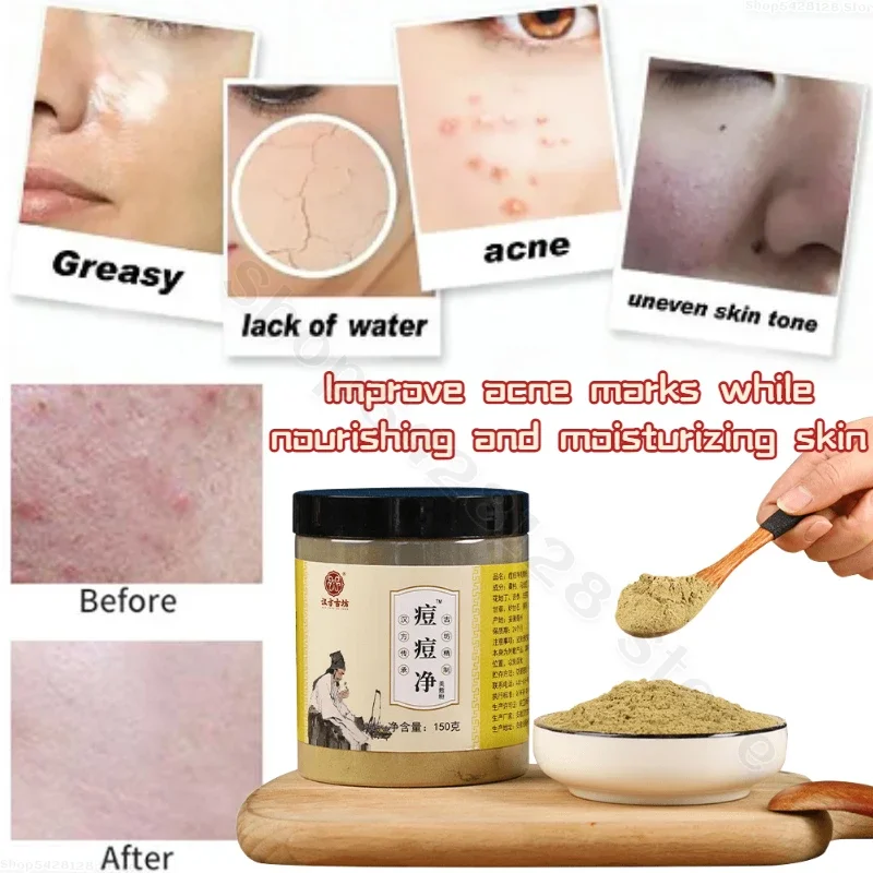 

Acne net powder herbal raw materials to repair acne marks to shrink pores facial acne powder 150g canned