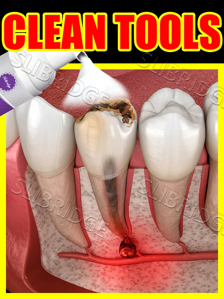 

Mousse shield, no way to decay.,Free shipping,New upgrade 3.0 Intraoral Mousse clean tools