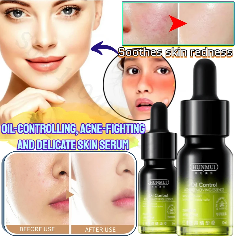 

Soothing Skin, Oil-controlling and Acne-removing Essence, Repairing Redness, Acne-suppressing and Delicate Skin Essence Essence
