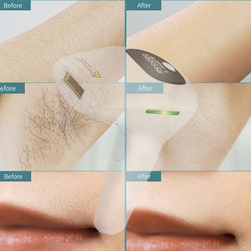 999999เลเซอร์กำจัดขนแบบแฟลชเครื่องกำจัดขนบิกินี่ตัวอุปกรณ์เลเซอร์สำหรับบ้านสนับสนุนการดรอปชิป