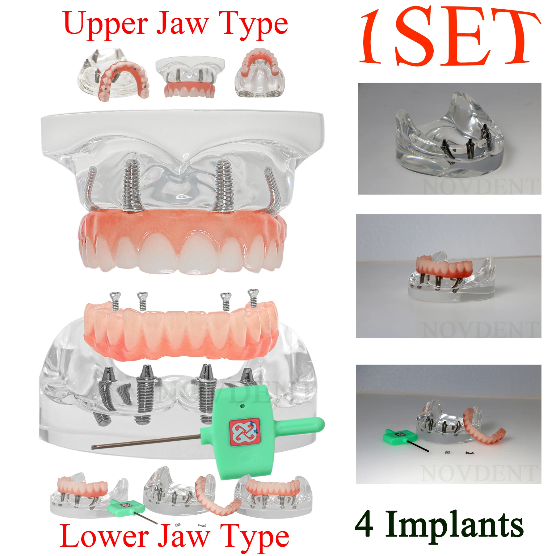 Dental Implant Models Transparent Upper/Lower Jaw Overdenture Restoration Removable Teeth Model Dentisit Teaching Demo Model