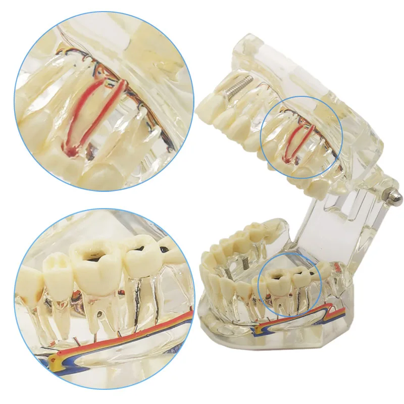 Dental Implant Model Teeth Neural Repair Resin Models Of Diseased Teeth for Dentist  Teaching and Research In Dental Diseases