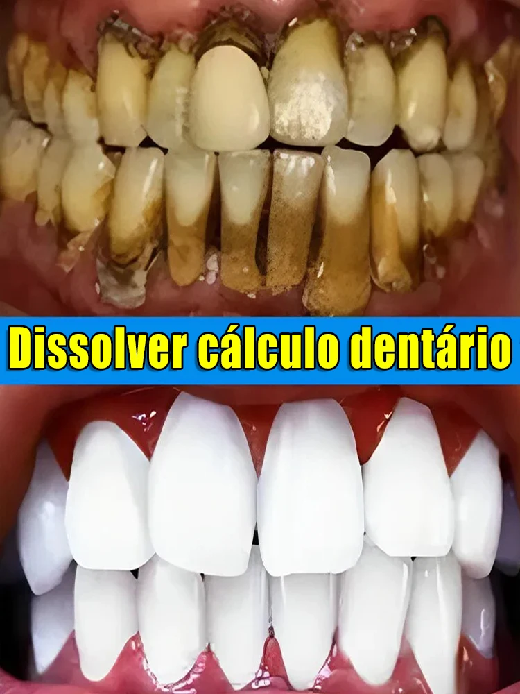 Removedor de cálculo Dental, eliminación de mal aliento, blanqueamiento de dientes, pasta de dientes, brillo, prevención de la Periodontitis,