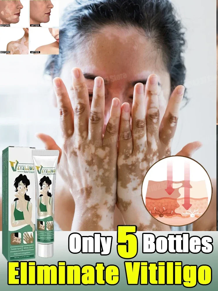 Vitiligo Safe Repair Brightening Lasting Increase Confidence Improve Skin Appearance Natural Ingredients