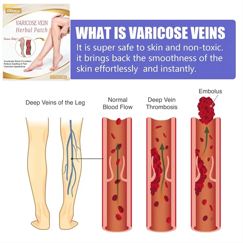 Эффективная наклейка для облегчения варикозного расширения вен, устранение сосудистой сетки, лечение флебита, успокаивающее средство для облегчения