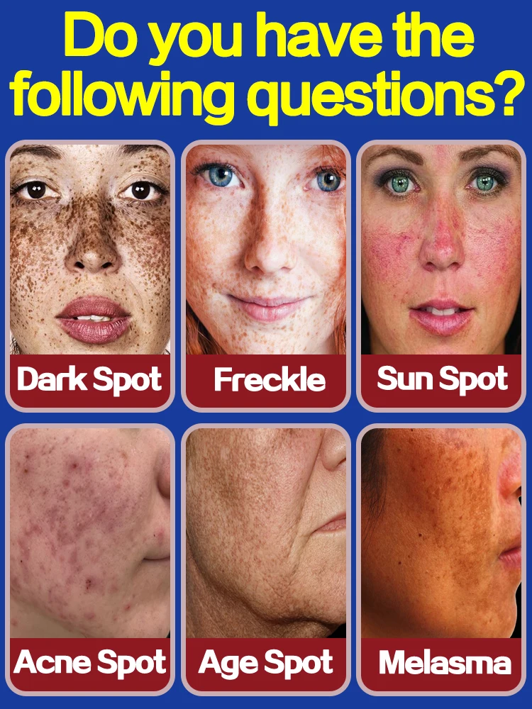 Solve all dark spots troubles