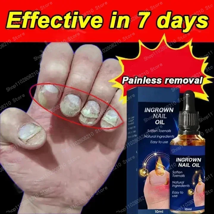 HOT SALE Fungal Nail Removal ML Fungal Nail Foot Repair Essence Toe Nail Fungus Removal Gel Anti Infection