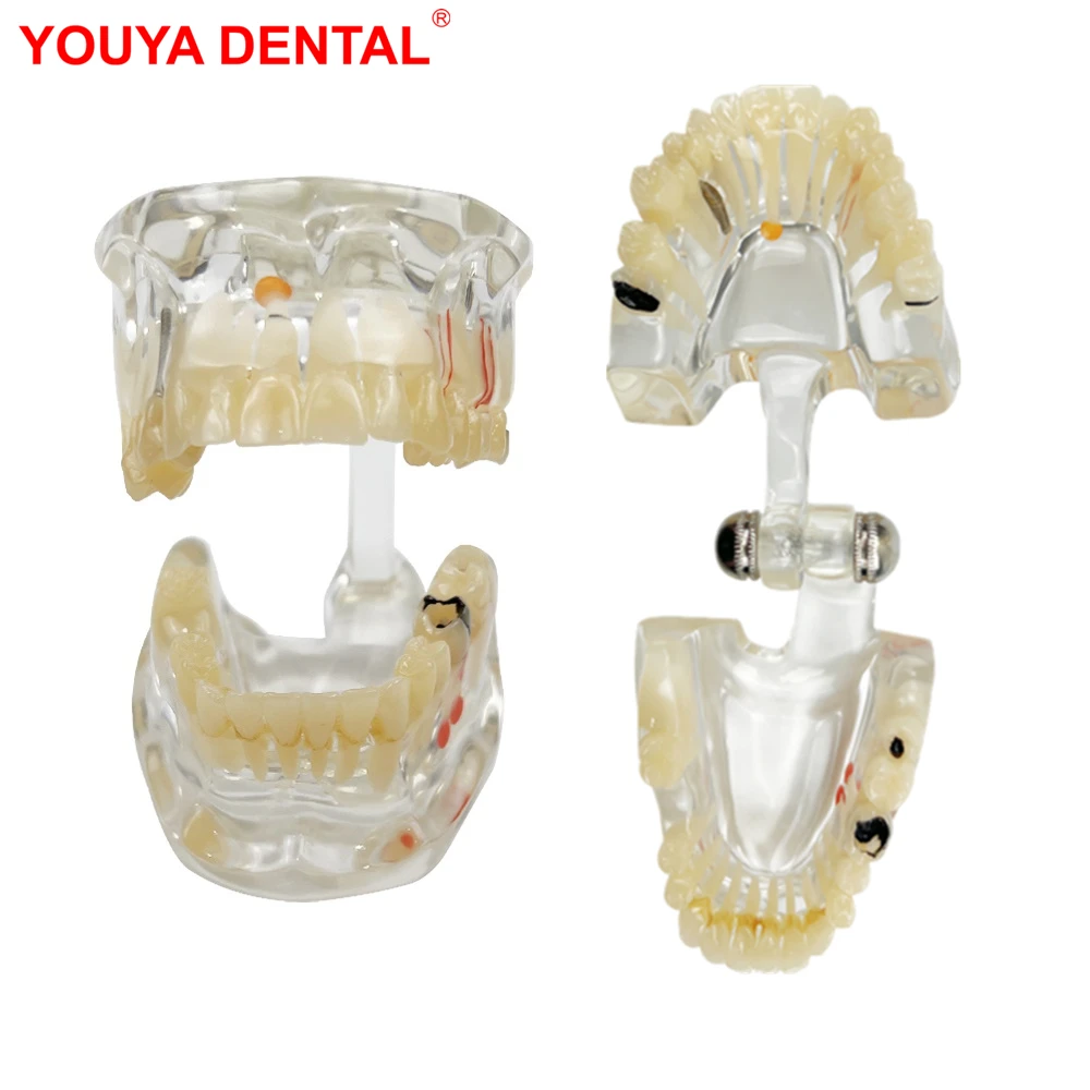 Dental Caries Model Disease Teeth Dental Model Missing Elongation Tooth Model For Patient Education Teaching Studying Display