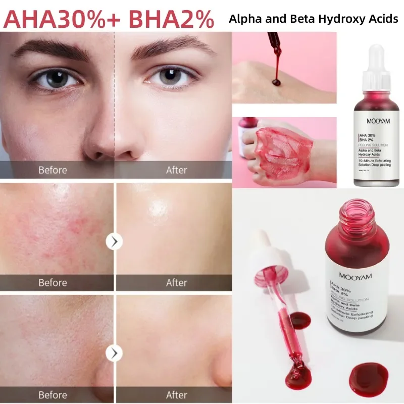 AHA30% BHA2% Glycolic Acid Peeling Solutions Acne Serum Facial Exfoliating for Dark Spot Shrink Pore Reduce Fine Line Wrinkle