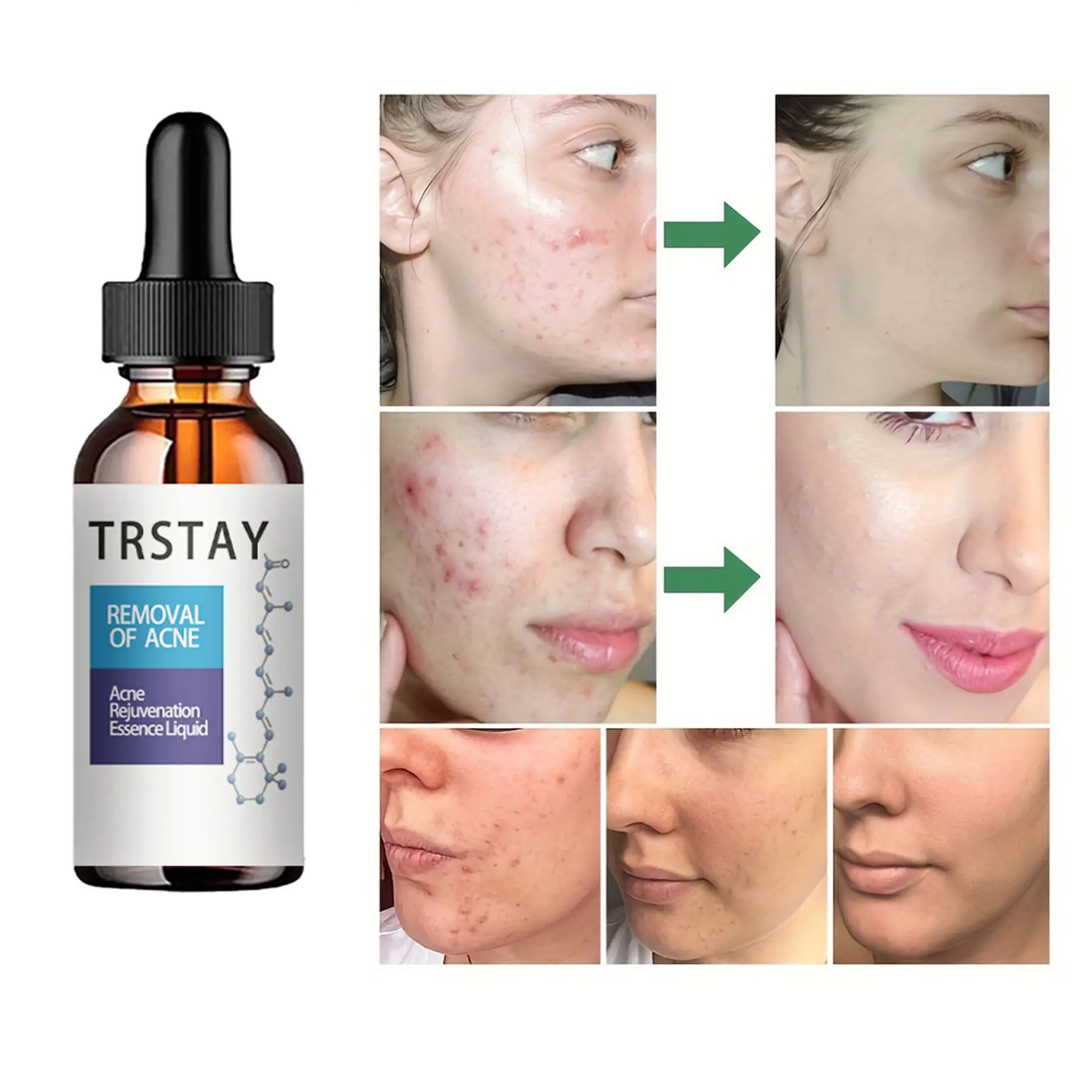 

Acne Treatment essence Oil Control and Pore Shrinking Whelk Skin Care Facial Scar Moisturizing Anti Acne essence