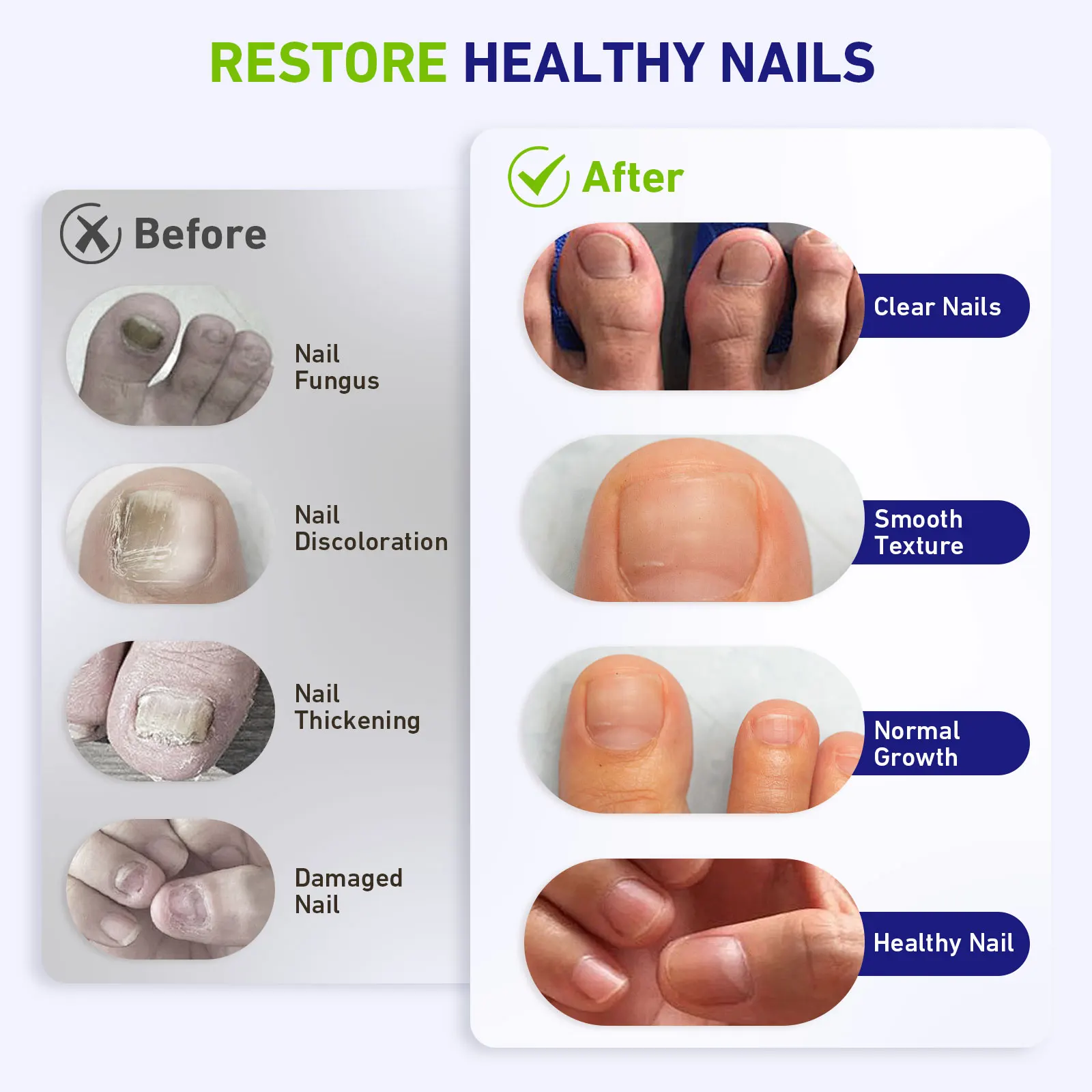 57 خرزة جهاز ليزر فطريات الأظافر لأظافر القدم فطار الأظافر معدات ليزر منزلية مضادة للفطريات 470 نانومتر 660 نانومتر خمسة أظافر معًا