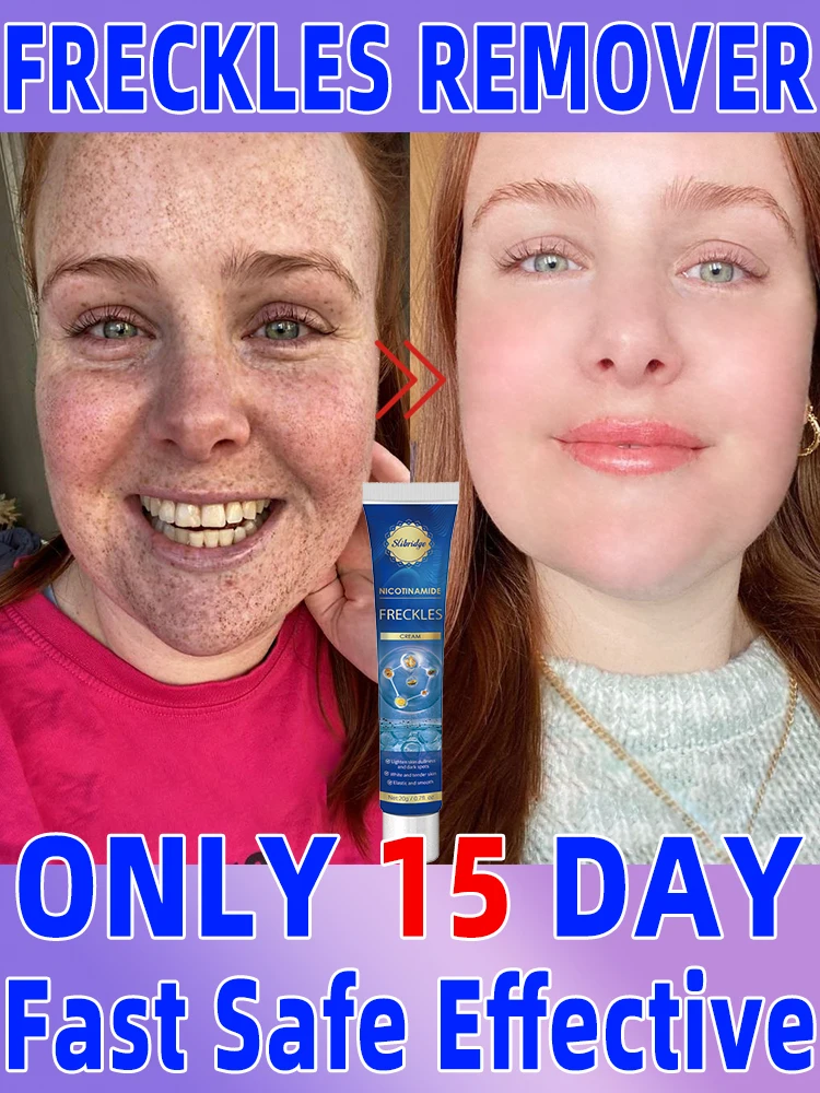 Freckles Chloasma Age Sun Dark Spot Clear