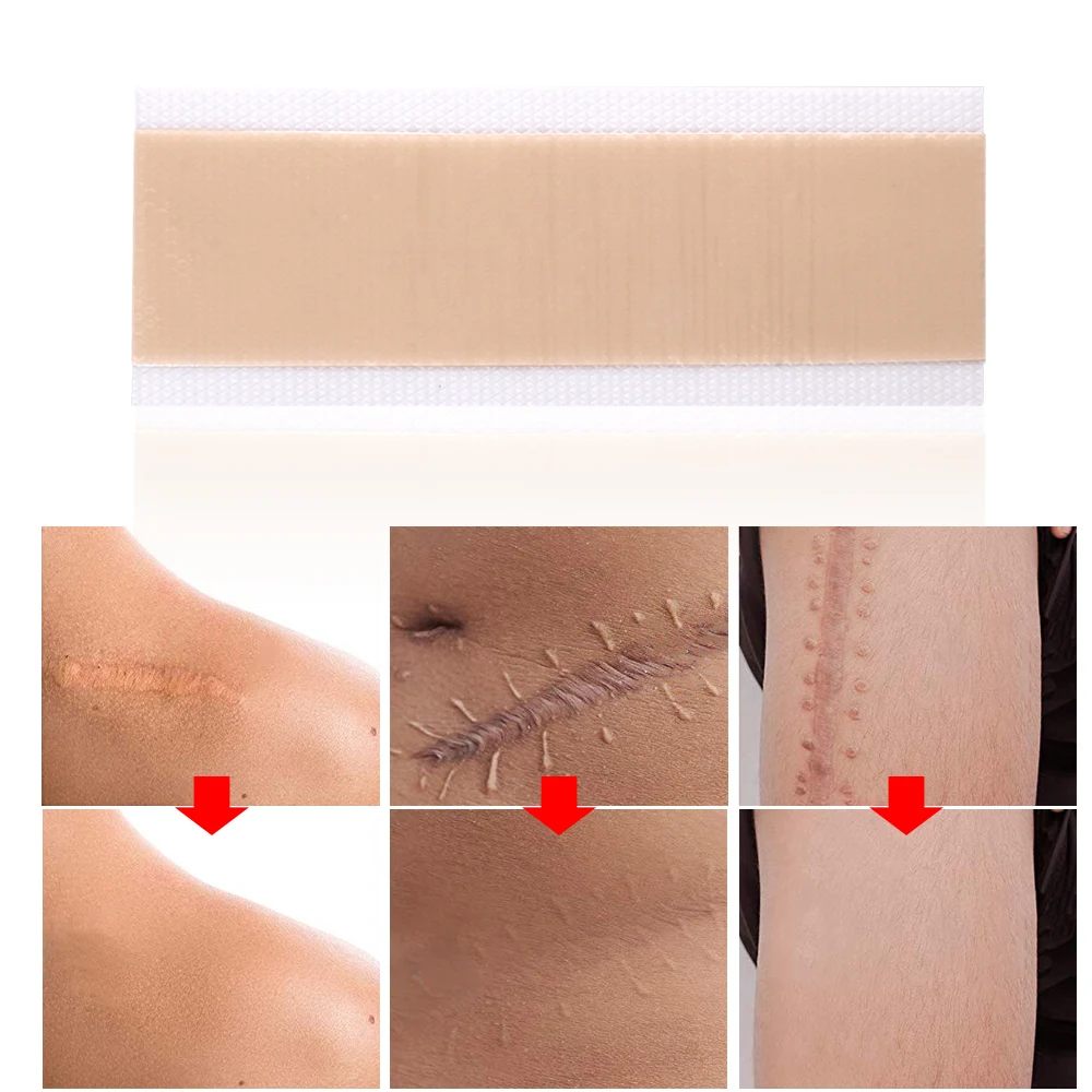 4x15cm Burn Scar Patches Remove Silicone Patch Treatment Wounds Cover Tape Caesarean Section Burn Acne Sheet Beauty Skin Repair