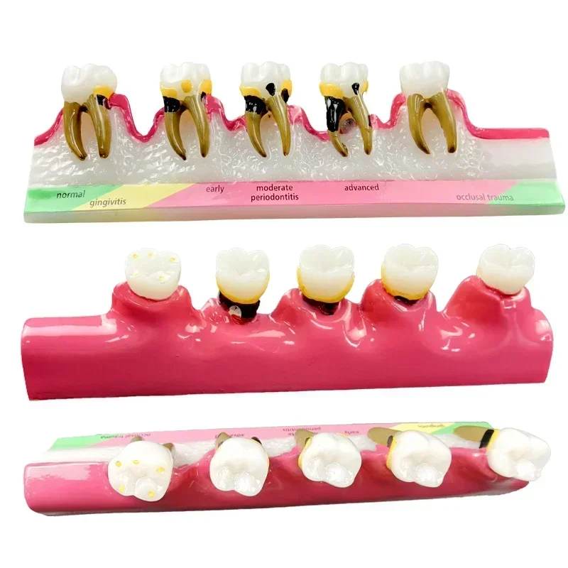 

Dental Periodontal Disease Assort Demo Teeth Model 5 Stage Three-Dimensional Proportional Magnification Design for Dentist