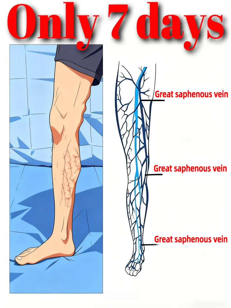 O laser de segunda geração diz adeus às pernas de aranha e varizes em 7 dias
