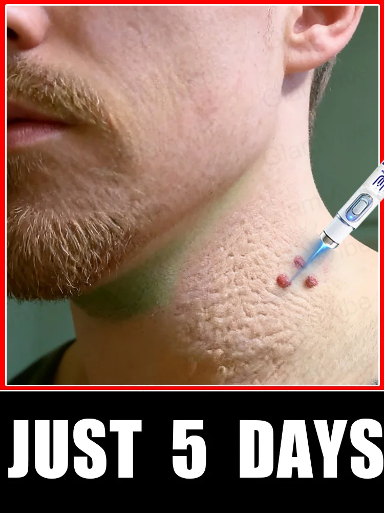 

2025 New Upgrade Blue Laser Solve Wart Tool