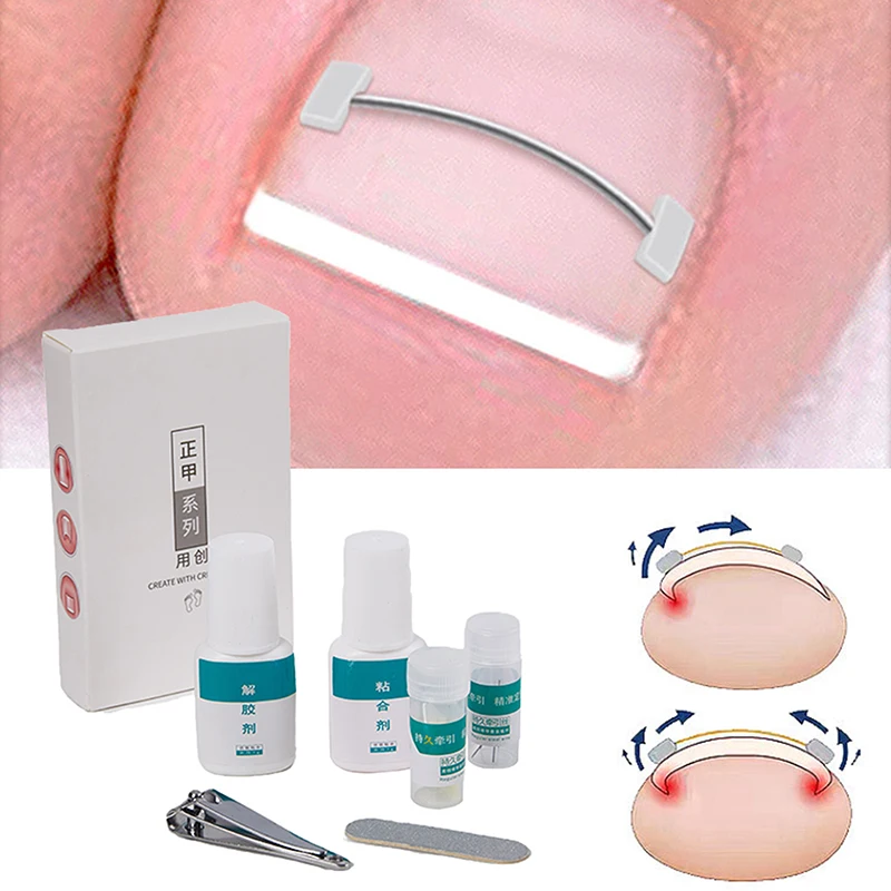 Corrector de uñas encarnadas, herramienta profesional para el cuidado de los pies, pedicura, tratamiento de uñas encarnadas