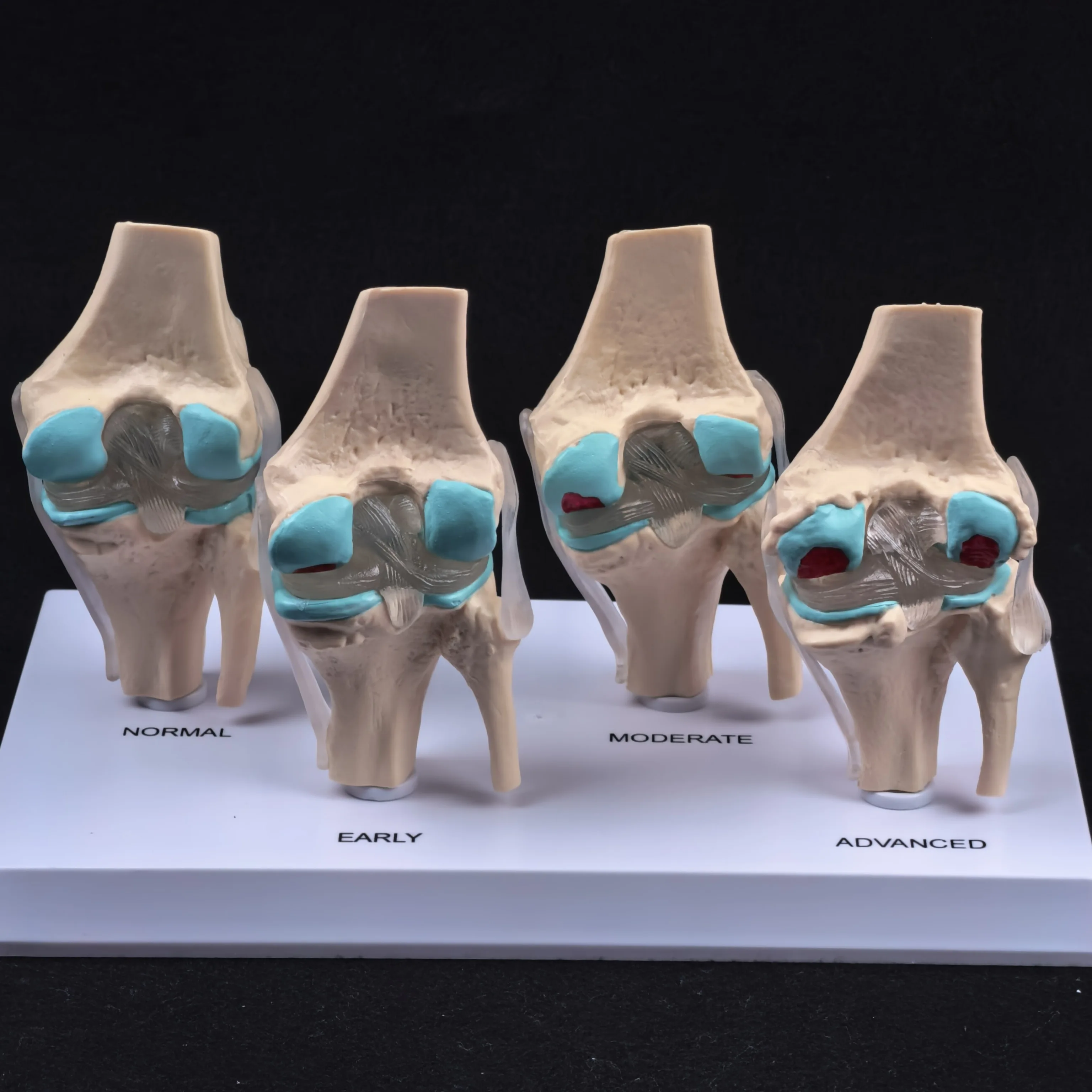 نموذج مرض مفصل الركبة التشريحي البشري المزخرف تشريح الهيكل العظمي الطبي موارد التدريس PVC #3