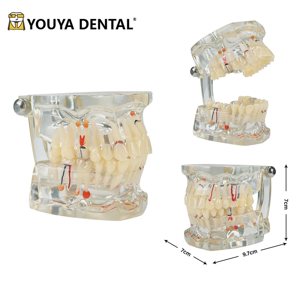 

Dental Teeth Implant Pathology Model Practice Model for Dentist Technician Student Studying Doctor-patient Communication