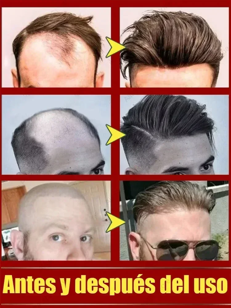 99% of buyers buy again, have more and more hair, say goodbye to baldness, thick hair,Hot selling product