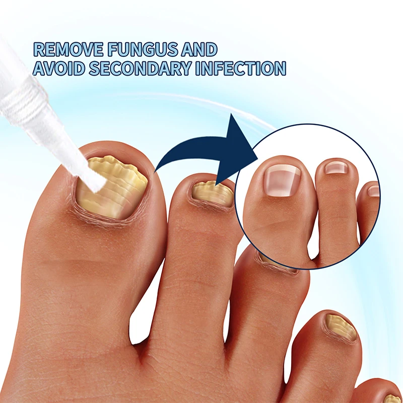 Ingrown Prego Repair Pen, Espessamento Tipo, Reparação Hidratante, Mão e Pé Onicomicose Correção Pen