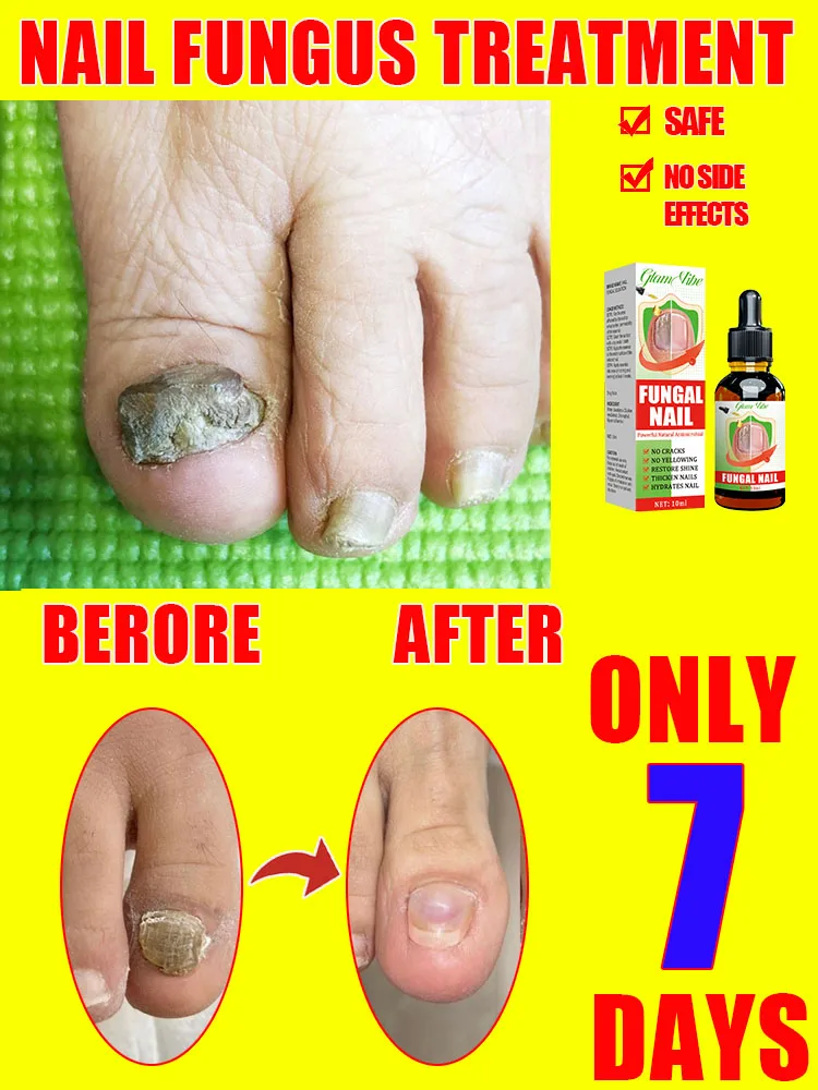 

ᴺᵃⁱˡ ᶠᵘⁿᵍᵘˢ ᵗʳᵉᵃᵗᵐᵉⁿᵗ ᵉˢˢᵉⁿᵗⁱᵃˡ ᵒⁱˡ⸴ ʳᵉᵖᵃⁱʳ ᵒⁿʸᶜʰᵒᵐʸᶜᵒˢⁱˢ ⁱⁿ ⁷ ᵈᵃʸˢ