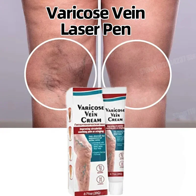 

Varicose Veins Cream Phlebitis Varicosity Angiitis Plaster Spider Leg Ointment For Relief Leg Pain Numbness