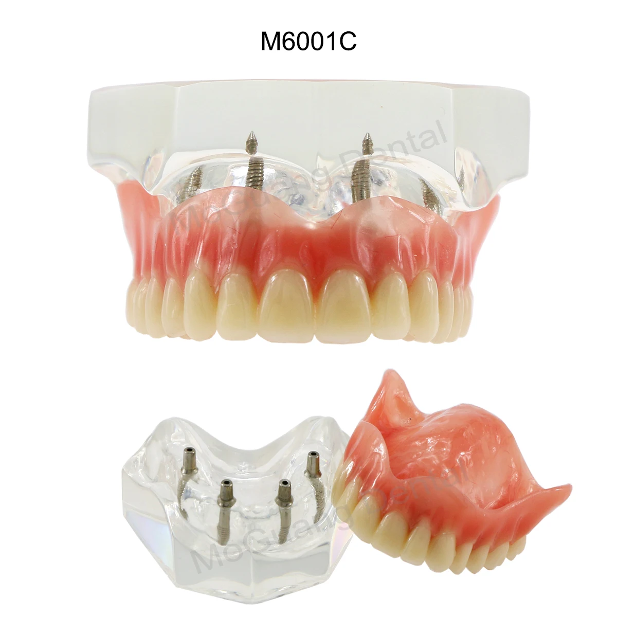 Dental Model with Removable and Restorable Teeth Dental Education Model Implant Overdenture Teeth for Researching  Medical