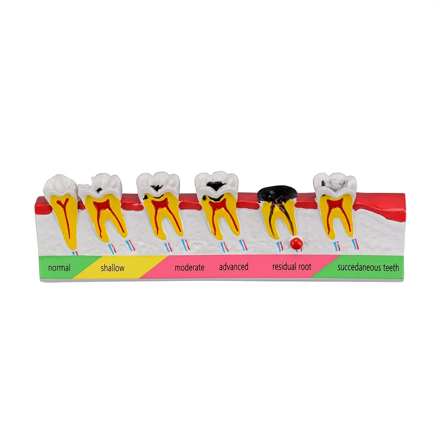 

Dental Caries Developing Model, Dental Teeth Model for Dental Tooth Anatomy Study, Doctor-Patient and Oral Care Education