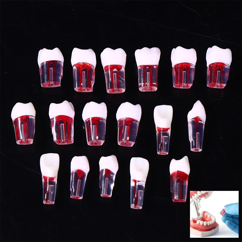 

5/10 шт. стоматологическая модель эндодонтических зубов RCT, эндодонтический блок корневых каналов, пульлообразная полость, смола, учебная практика, эндодонтическое обучение