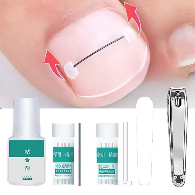 Ingrown Toenail Corrector Tools Pedicure Recover Embed Toe Nail Treatment Professional Ingrown Toenail Straightening Clip Brace