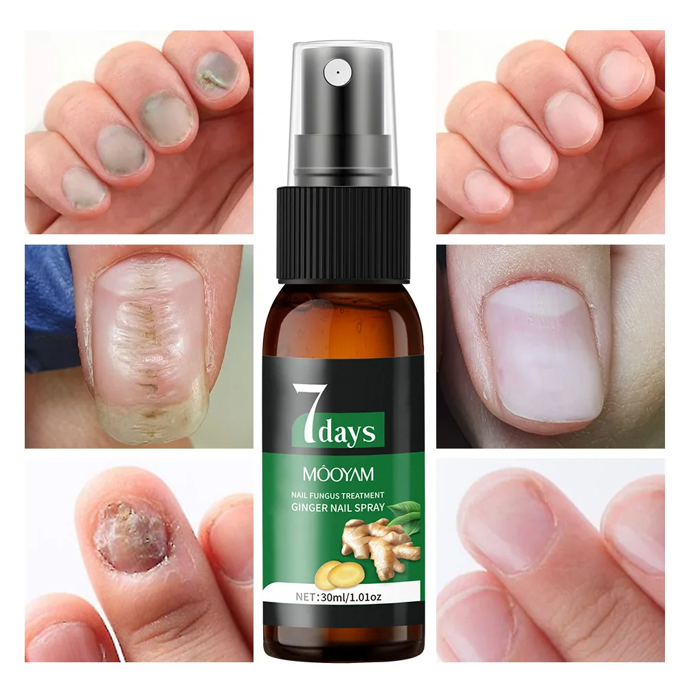 Sérum de traitement des champignons des ongles, 7 jours, élimination des champignons des orteils, Essence Anti-Infection, Onychomycose, Paronychia, produits de soins des ongles